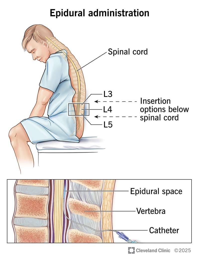 Diagram of an epidural catheter inserted into the lower back